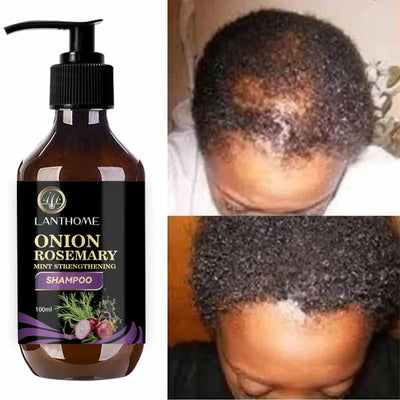 100ML Hair Shampoo For Fast Hair Growth Rosemary Onion Shampoo Spray Anti Hair Loss Effective Within 7 Day Hair Growth Product